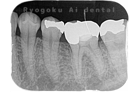 C3虫歯、インレー不適合