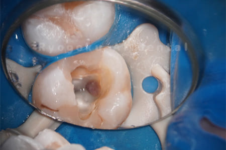 C3、重度カリエス