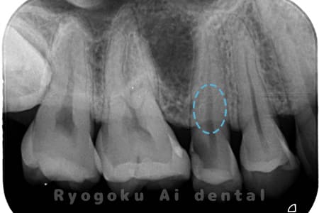15部重度カリエス