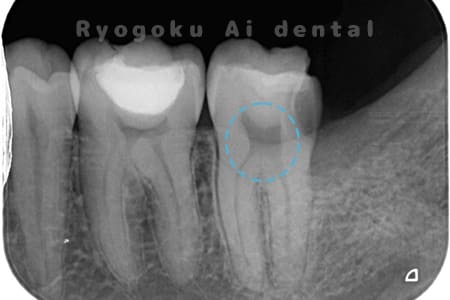親知らずの抜歯