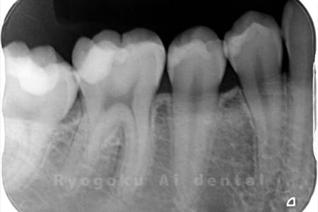 断髄治療前レントゲン