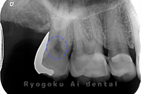 断髄治療前レントゲン