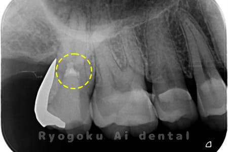 断髄治療後レントゲン