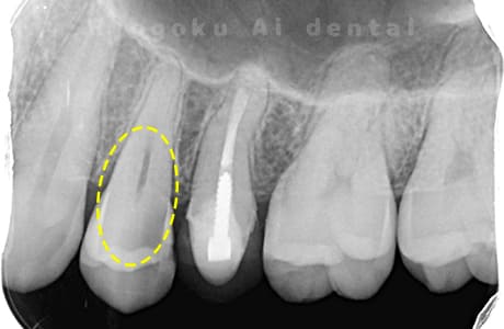 C3重度齲蝕レントゲン
