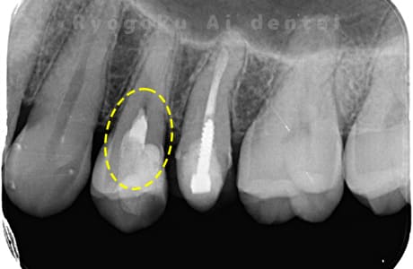 断髄治療後レントゲン