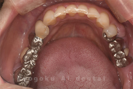 右下5・6番歯根破折