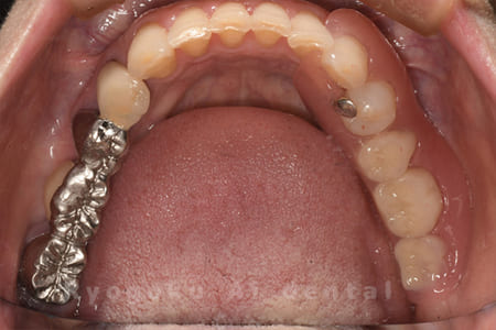 ノンクラスプデンチャー