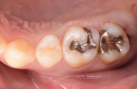 メタルインレー 2次カリエス