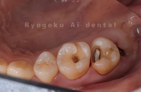 臼歯部のセラミックインレーとダイレクトボンディング術中