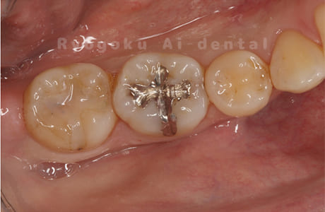 メタルインレー 2次カリエス