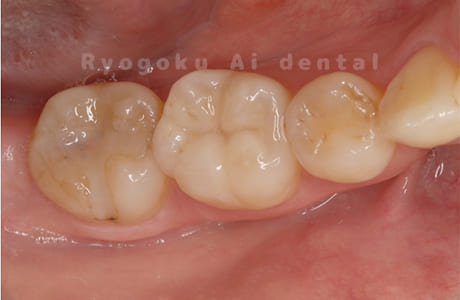 ダイレクトボンディング