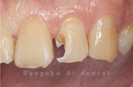 前歯部CR 2次カリエス