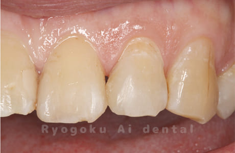 ダイレクトボンディング