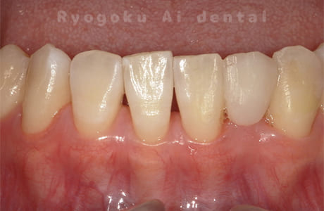 ダイレクトボンディング