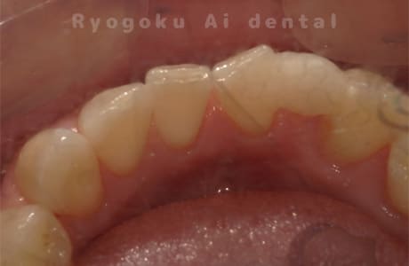 ダイレクトボンディング