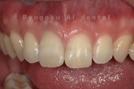 ダイレクトボンディング