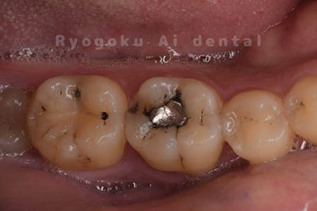 アマルガム充填不適合、CR充填不適合
