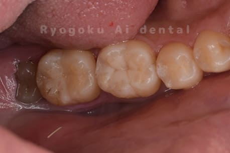 ダイレクトボンディング