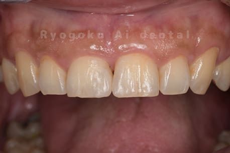 ダイレクトボンディング