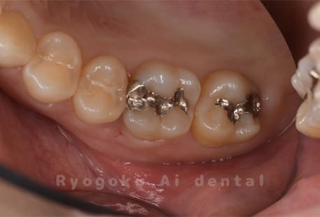 メタルインレー 2次カリエス