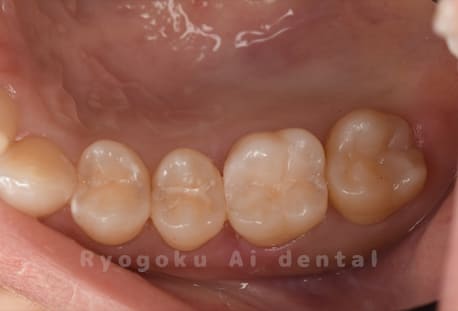 ダイレクトボンディング