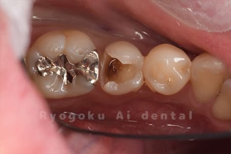 ダイレクトボンディング、セラミックインレー術中