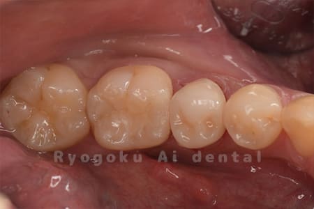 ダイレクトボンディング、セラミックインレー