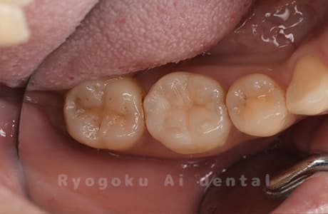 ダイレクトボンディング術中