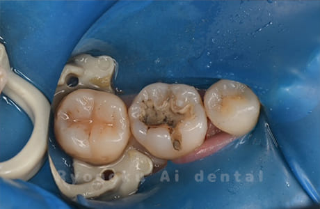 インレー不適術前
