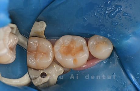 ダイレクトボンディング