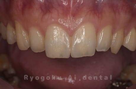 ダイレクトボンディング