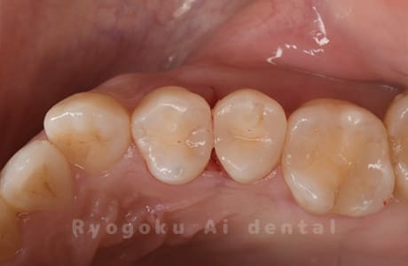 14ダイレクトボンディング、15セラミックインレー