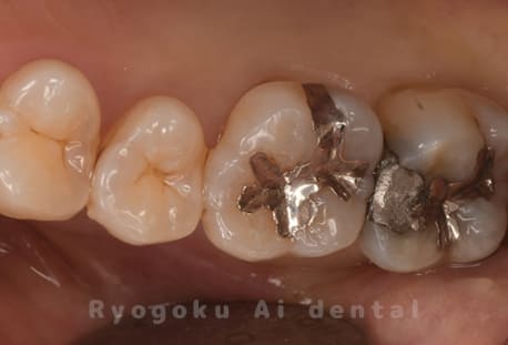 インレー2次カリエス