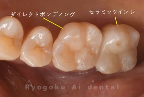 左上６番→ダイレクトボンディング、左上７番→セラミックインレー