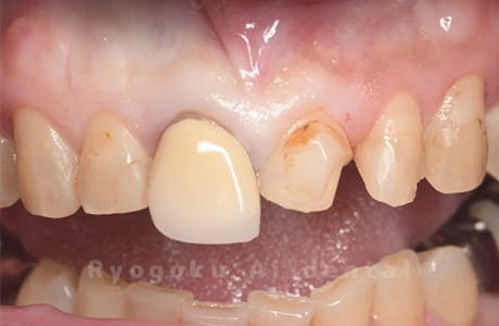 左上１番歯牙破折