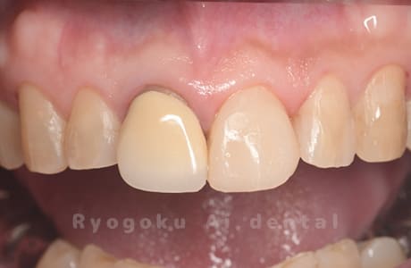 ダイレクトボンディング