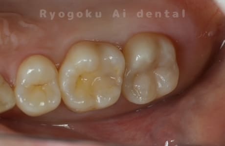 ダイレクトボンディング