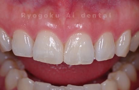 ダイレクトボンディング