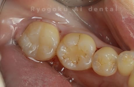 ダイレクトボンディング