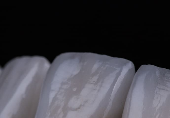 最短1日で白い歯になるダイレクトボンディング