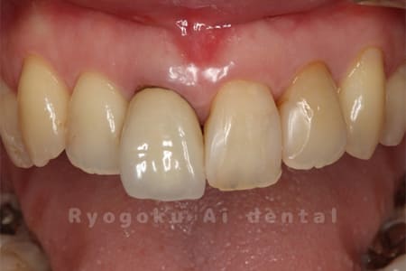 右上1番、不良補綴