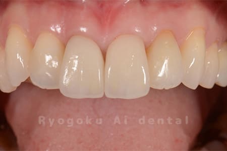 前歯部ジルコニアセラミッククラウン