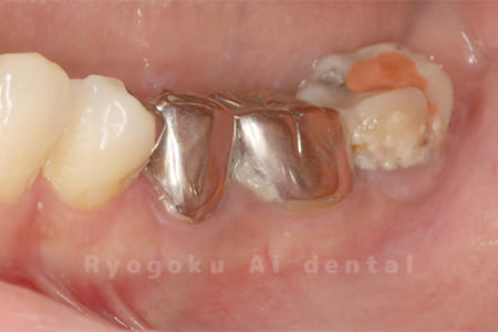 縁下カリエス、慢性根尖性歯周炎、不良補綴
