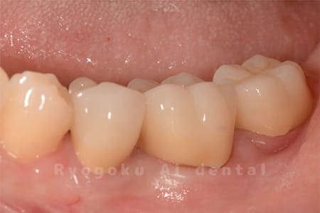 クラウンレングスニング、マイクロエンド、フルジルコニアクラウン