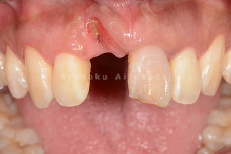 前歯部の自然脱落、慢性根尖性歯周炎