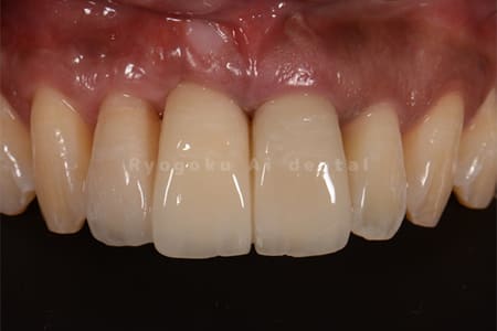 ジルコニアセラミックブリッジ