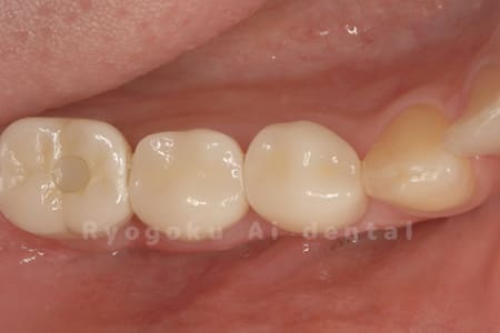 術後咬合面e-max