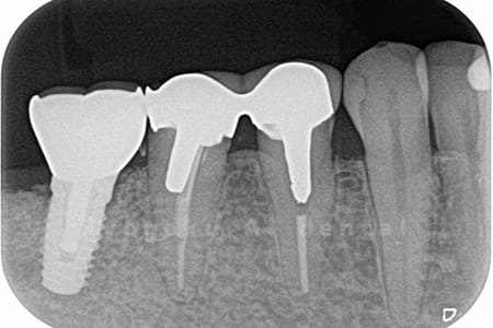 レントゲン写真術前