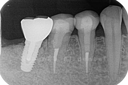 レントゲン写真術後