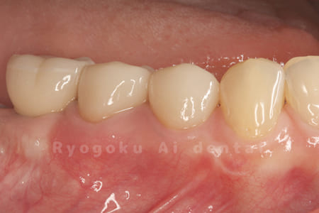 e-maxクラウン装着後